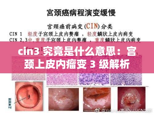cin3 究竟是什么意思：宫颈上皮内瘤变 3 级解析