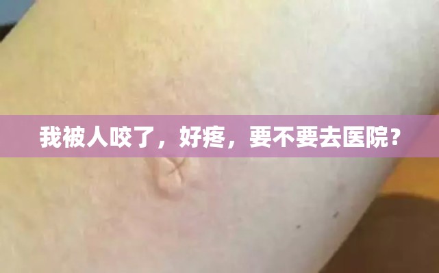 我被人咬了，好疼，要不要去医院？